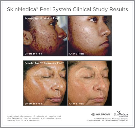 Illuminize Peel Before And After Photos - Draw-heat