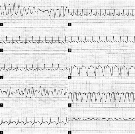 Fine Ventricular Fibrillation Vs Coarse Ventricular Fibrillation