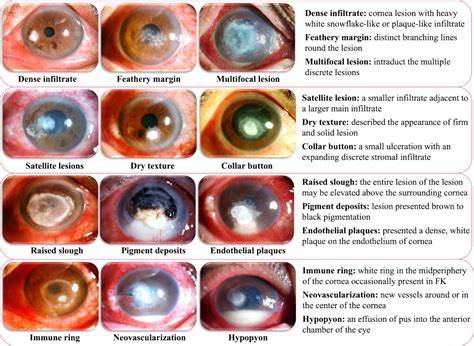 Microbial Keratitis