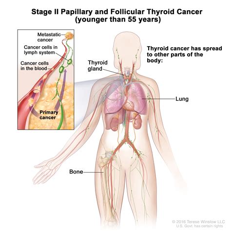 Thyroid Cancer Treatment (PDQ®)–Patient Version - NCI