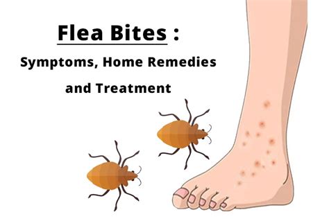 Flea Bites : Symptoms, Home remedies and Treatment