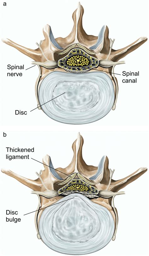 Lumbar laminectomy | healthdirect