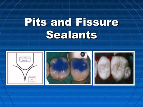 pits and fissure sealants dental material