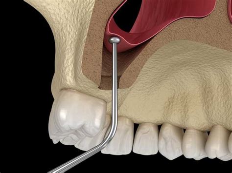 Sinus Lift Procedure by Expert Periodontist | New Bedford, MA | Center for Advanced Periodontics ...