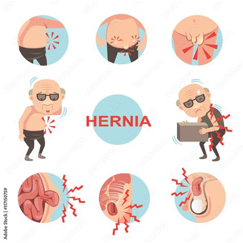 Hernia/Diagram of inside umbilical and inguinal hernia, Men with hernia symptoms and signs that ...