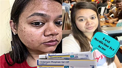 CLINDAMYCIN PHOSPHATE USP GEL | Pimple गायब हो जाएंगे | Cream for Acne & Pimple - YouTube