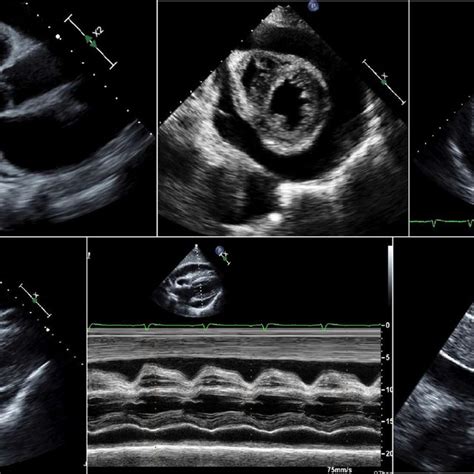 (PDF) Echo-Guided Pericardiocentesis: When and How Should It Be Performed?