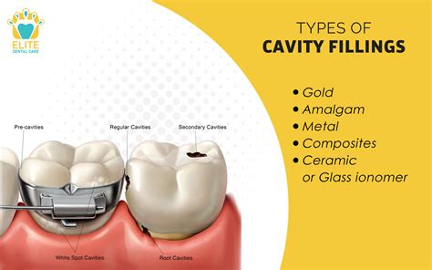 TYPES OF CAVITY FILLINGS - ELITE DENTAL CARE TRACY | Elite Dental Care