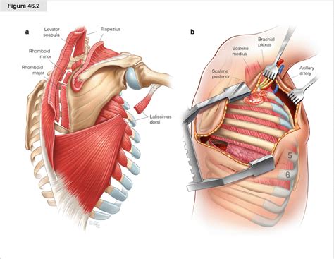 Anterior Approach To Superior Sulcus Lesions Thoracic Key | My XXX Hot Girl