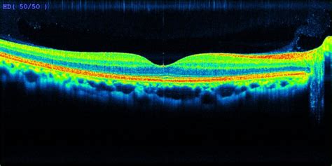 Berwick Family Eyecare | OCT Imaging