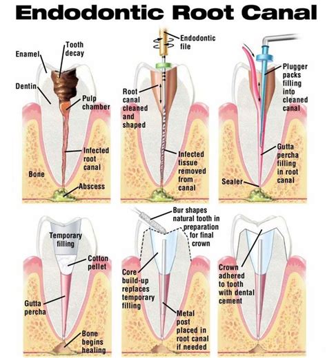 Endodontic Root Canal | Dental Anecdotes | Pinterest