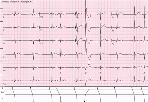 Rabbit-ear sign | ECG Guru - Instructor Resources