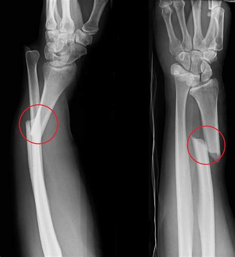 Galeazzi Fracture Treatment | Galeazzi Bone Fracture Surgery