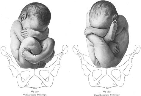 Fetal Positions Can Affect Childbirth: Most Cause Cesarean Birth | Youth Health Magzine