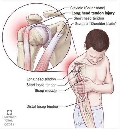 Long Head of the Biceps Tendinopathy - The Climbing Doctor