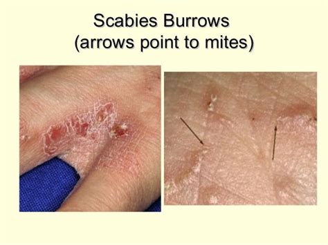 scabies tracks - pictures, photos