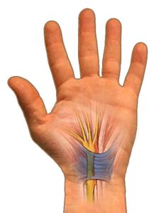 What is Carpal Tunnel Syndrome?