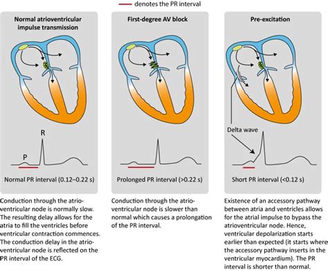 ECG interpretation: Characteristics of the normal ECG (P-wave, QRS complex, ST segment, T-wave ...