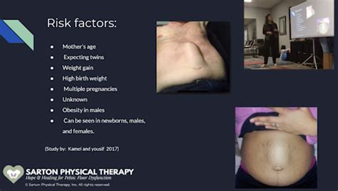 Diastasis Recti: Diagnosis, Exercises & Misconceptions