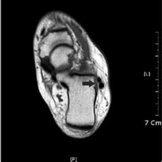 (PDF) Reliability of MRI Findings of Peroneal Tendinopathy in Patients with Lateral Chronic ...