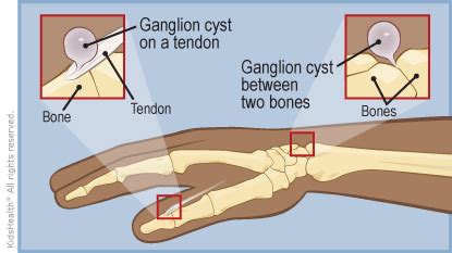 Ganglion Cysts | Rady Children's Hospital