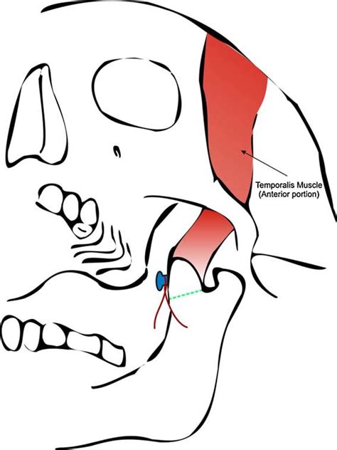 The coronoid process secured in the sagittal plane with a miniscrew and... | Download Scientific ...