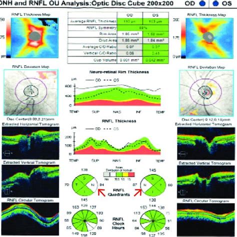 Optic nerve head OCT showed increased RNFL thickness on nasal quadrant... | Download Scientific ...