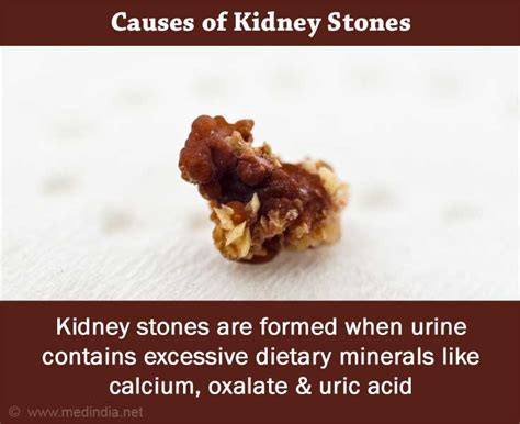 What are the Causes of Kidney Stones?