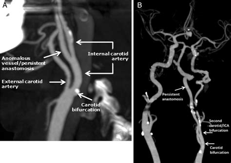 The transclival artery: a variant persistent carotid–basilar arterial ...