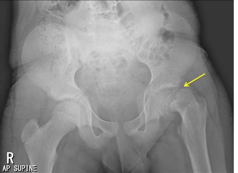 Slipped upper femoral epiphysis – Radiology Cases