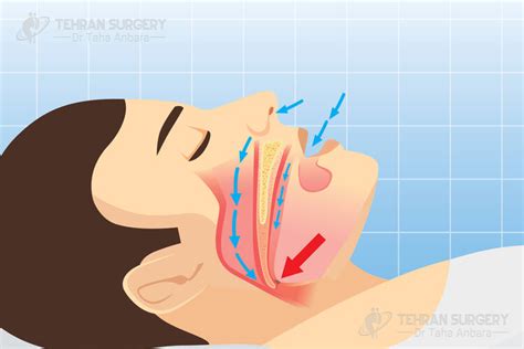 Obesity and sleep apnea - sleep apnea - Dr. Taha Anbara