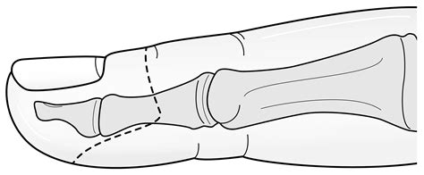 Transmetatarsal Amputation (TMA) and Toe Amputation | Treatments | Patients & Families | UW Health