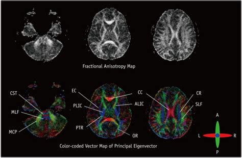 Gray and color scale fractional anisotropy maps. High signal on... | Download Scientific Diagram