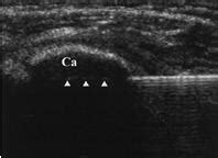 Ultrasound Guided Barbotage | ShoulderDoc by Prof. Lennard Funk