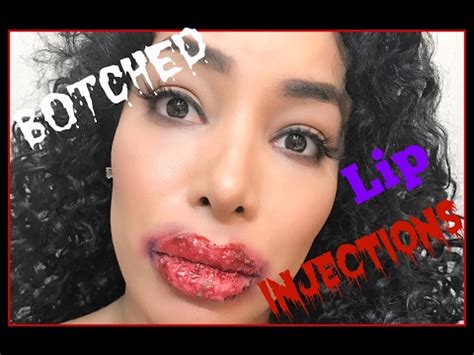 Botched Lip Injections!!! - YouTube