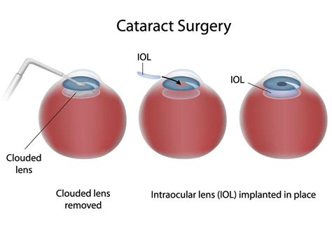 Cataract Surgery and Glaucoma - Glaucoma Associates of Texas