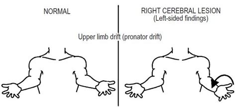 Pronator Drift (Barre’s sign) : Neurological Examination | Epomedicine