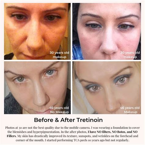 RETIN-A / Tretinoin For Wrinkles: Review & Before and After!