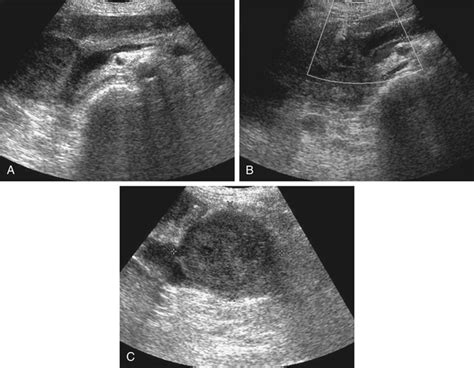 Epigastric Pain | Radiology Key