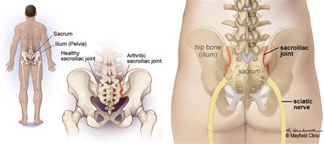 Relief from Sacroiliac Joint Pain — Sobel Spine and Sports