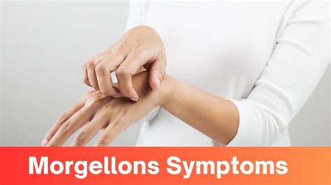 Unraveling Morgellons Symptoms: A Comprehensive Exploration » 2024