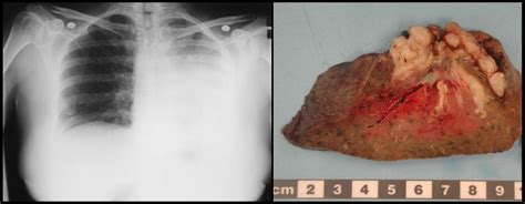 ABPA (allergic bronchopulmonary aspergillosis) - Life Worldwide