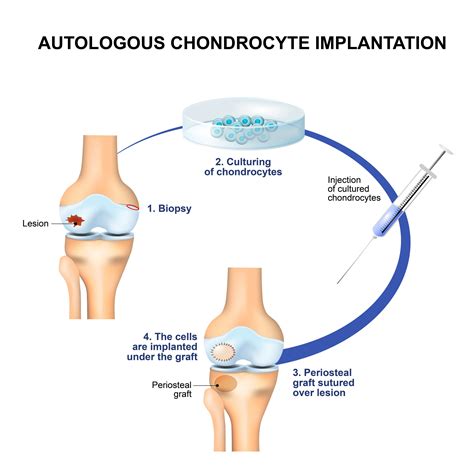 Alternatives to knee microfracture surgery and cartilage implant surgery