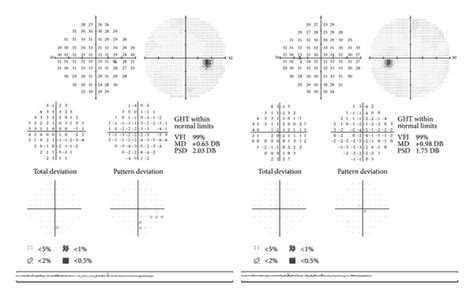 Zeiss Visual Field - Roswell Eye Clinic