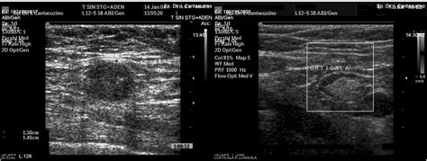 Ultrasound Axillary Imaging | IntechOpen