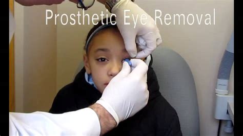 Artificial Eye Removal - YouTube