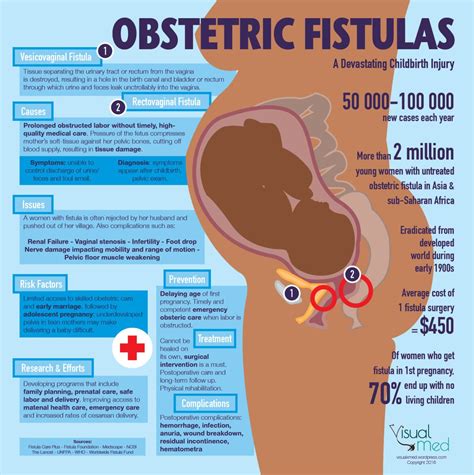 an info poster showing the benefits of obstetric fisulas