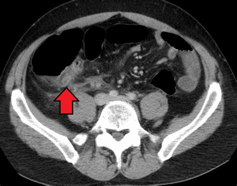 [Figure, CT abdomen showing appendicitis. Contributed...] - StatPearls ...