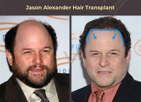 Jason Alexander Hair Transplant