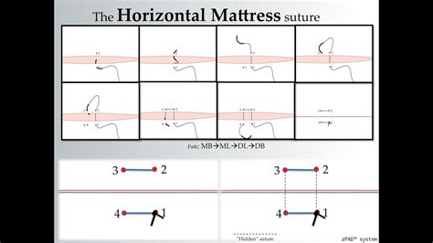 How to create a horizontal mattress suture? by SurgicalMaster™ - YouTube